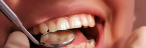 bellaire dental fillings