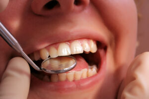 bellaire dental fillings