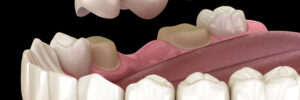 contemporary dental bridges