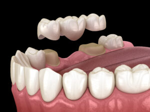 contemporary dental bridges