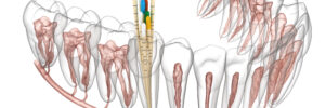 Bellaire root canals