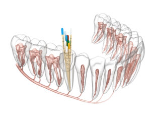 Bellaire root canals