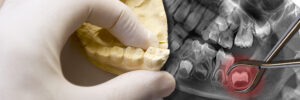 Bellaire tooth extraction