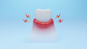 unhealthy Gum inflammation disease by gingivitis. Dental Gum and