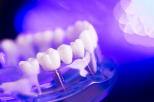bellaire dental implants