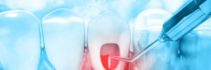 bellaire root canal therapy