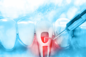 bellaire root canal therapy