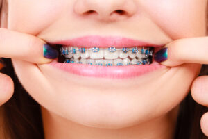 Bellaire, TX dentist offers invisalign and braces 