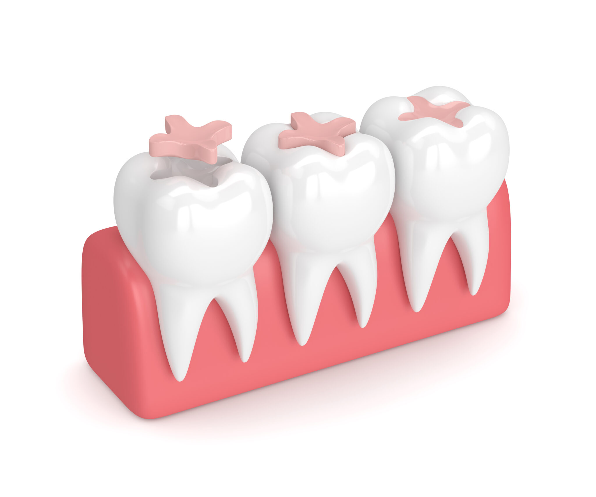 How A Tooth Filling Treats Your Cavity 