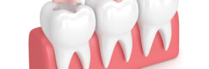 bellaire dental fillings