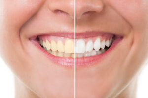 Bellaire, TX, dentist offers professional teeth whitening options 