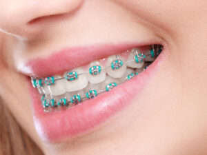 Bellaire, TX, dentist offers orthodontic treatments 