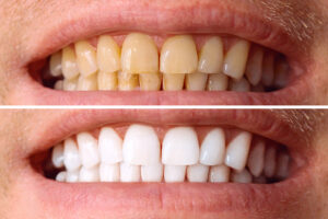 Bellaire, TX, dentist offers professional teeth whitening 